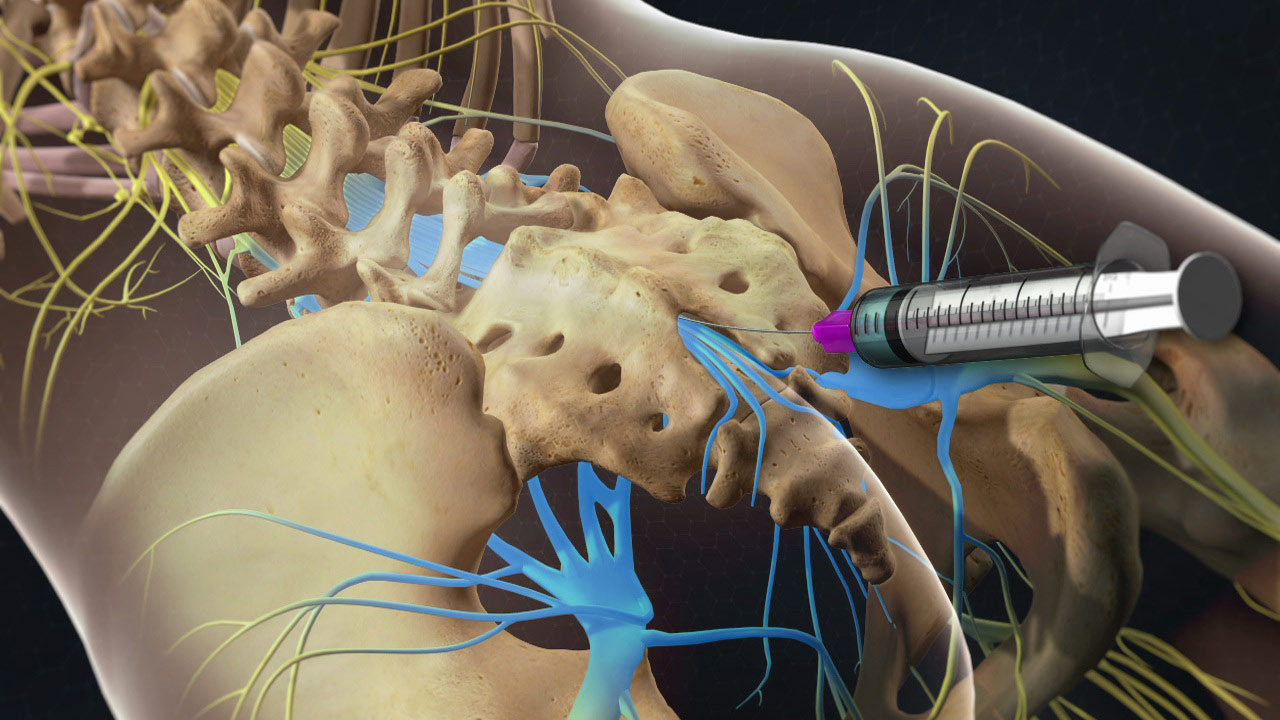 Epidural