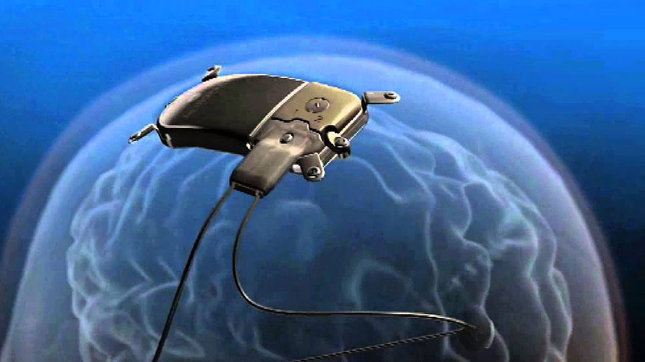 Neurostimulator