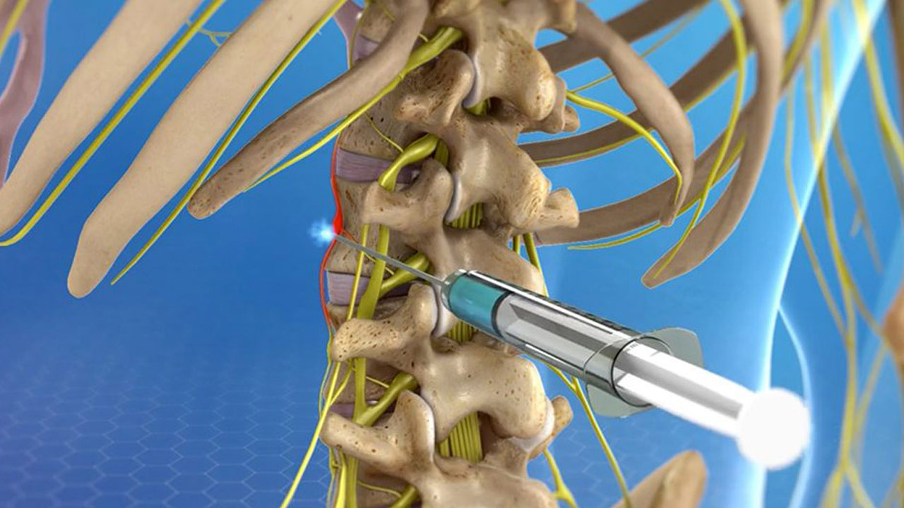 nerve-block