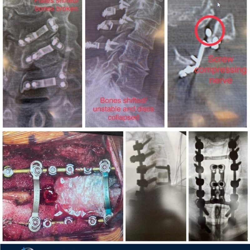 before and after - Spine Surgery