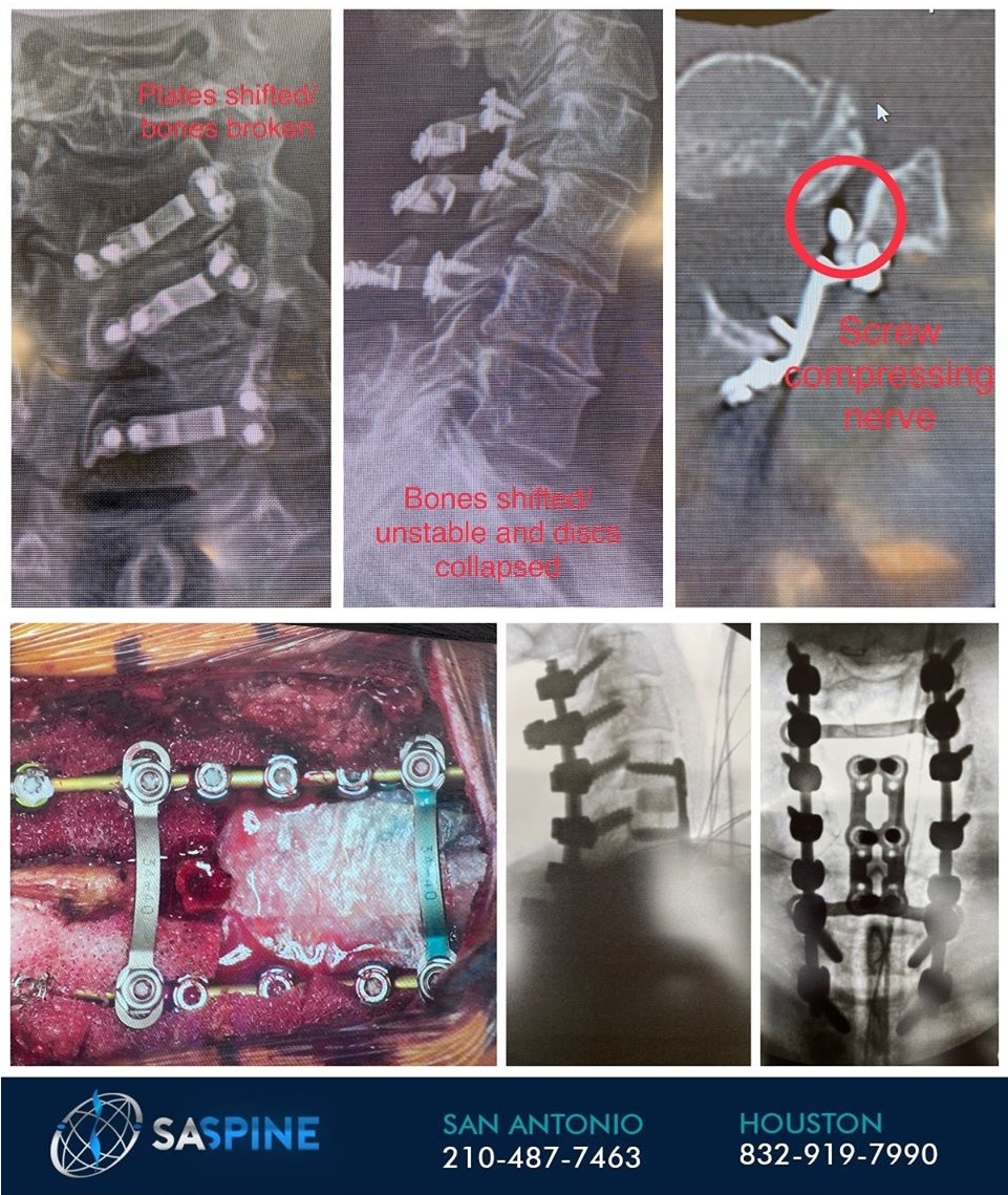 before and after - Spine Surgery