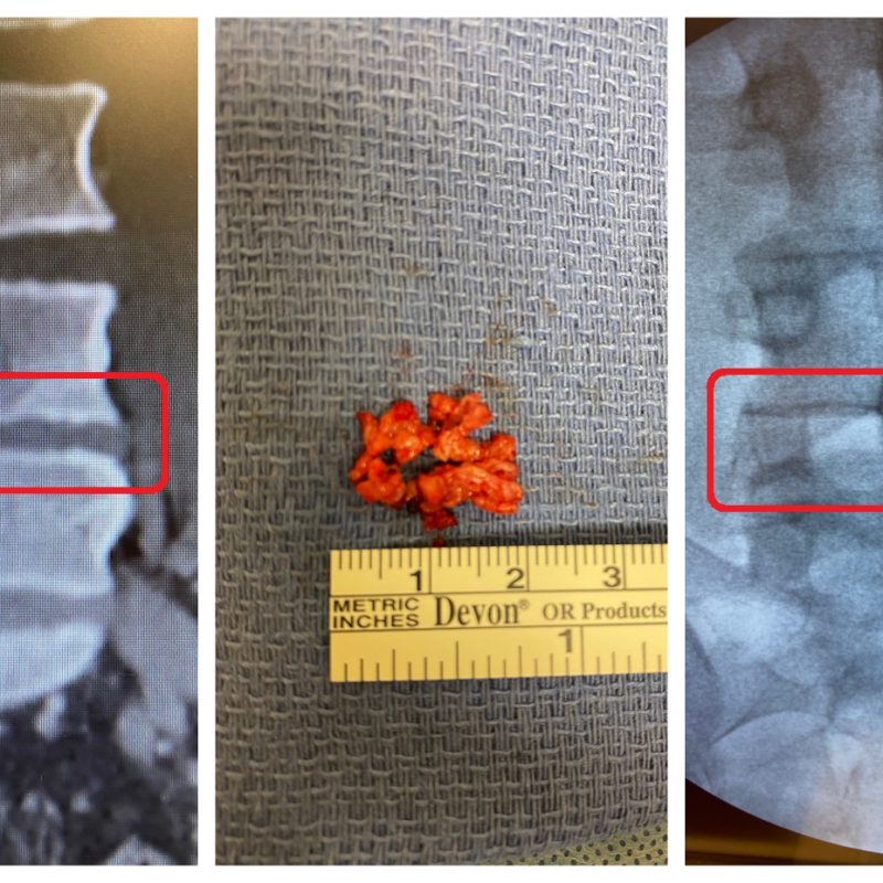 Herniated Disc