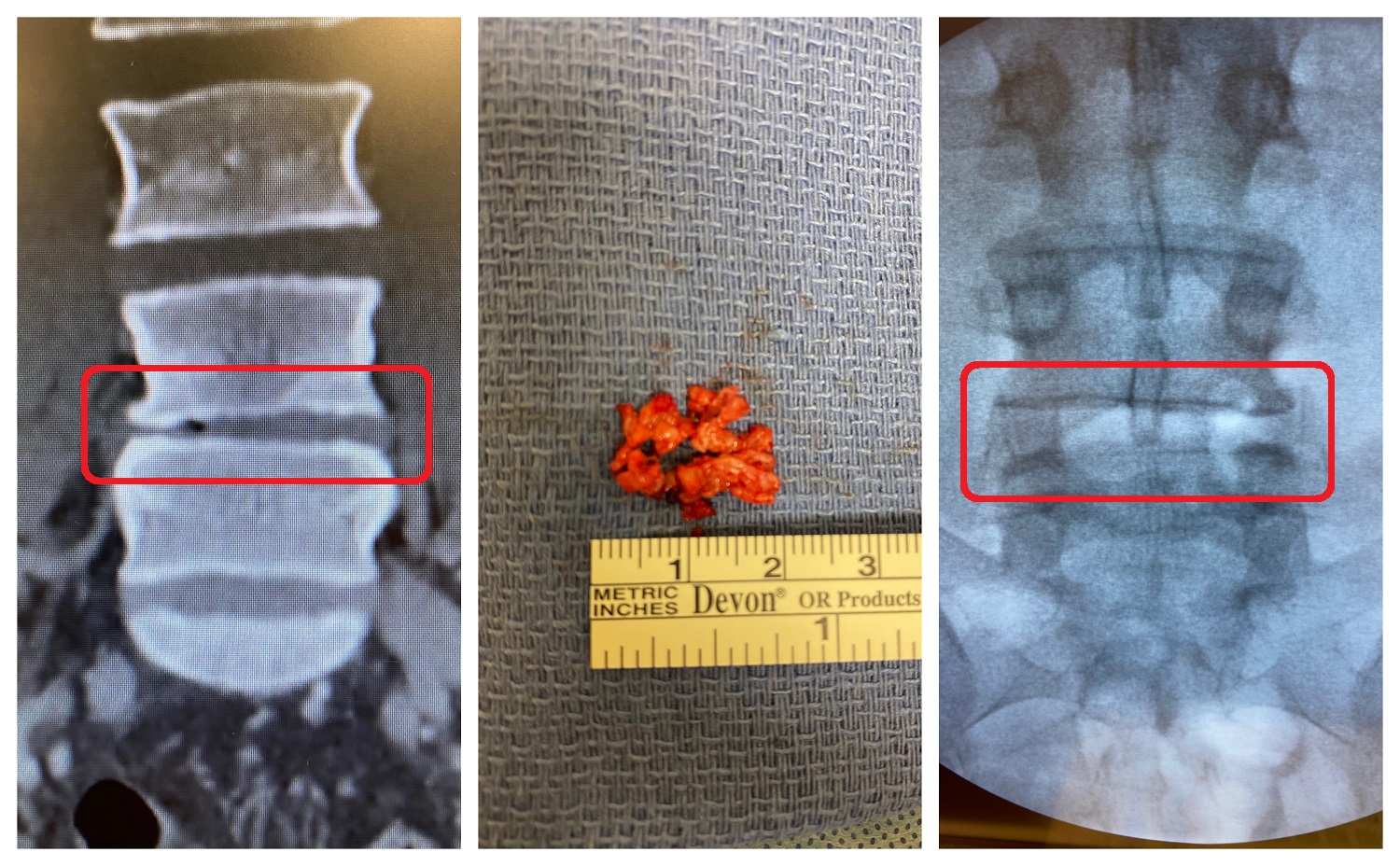 Herniated Disc