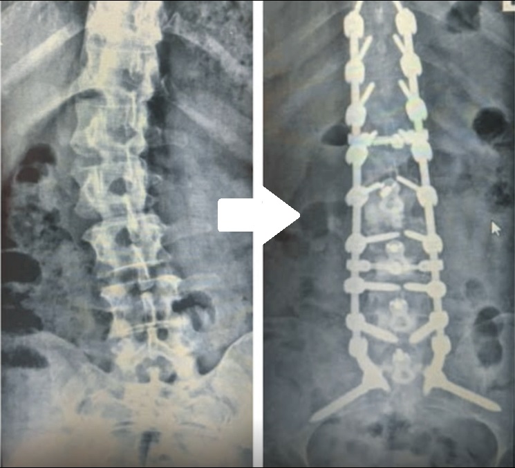 Before & After Spine Surgery