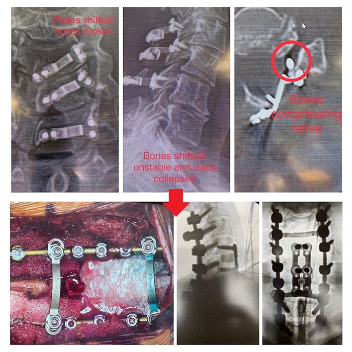 Laminoplasty - About Dr Cyr