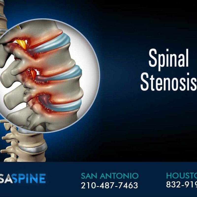 Spinal Stenosis Recommendation