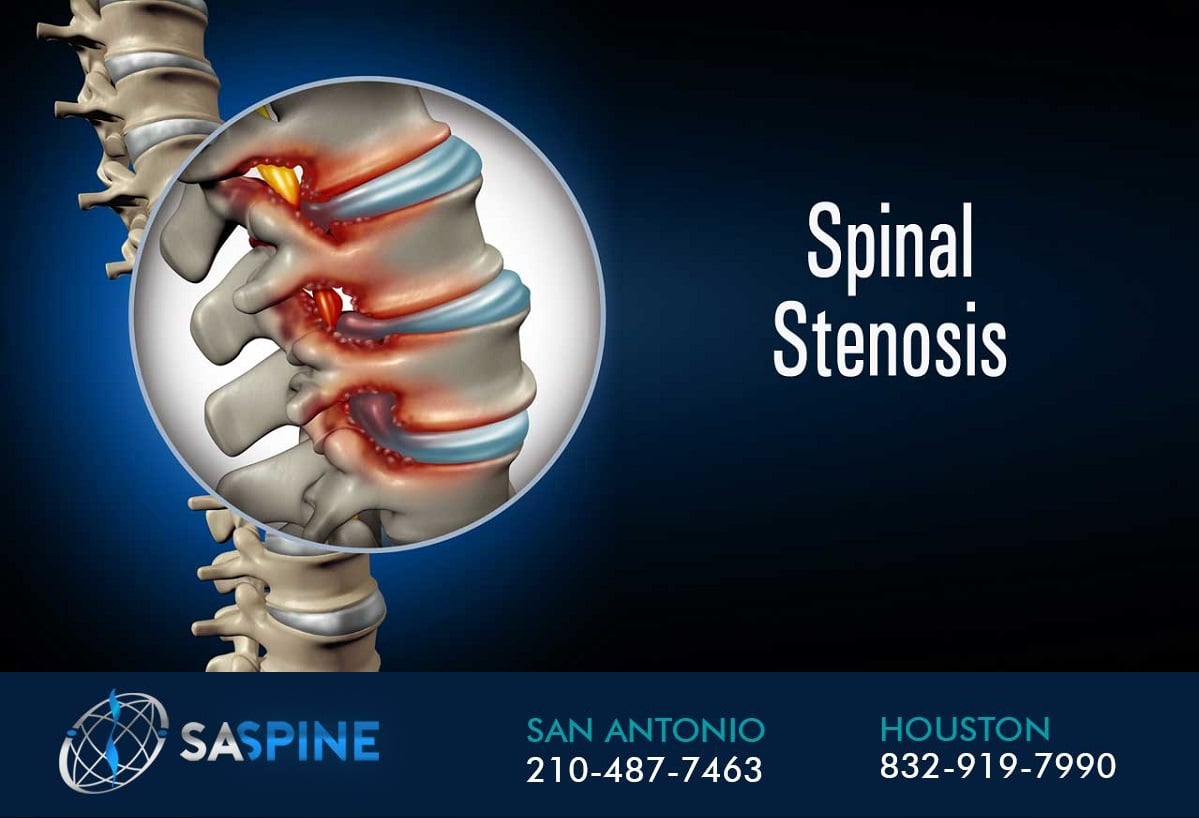 Spinal Stenosis Recommendation