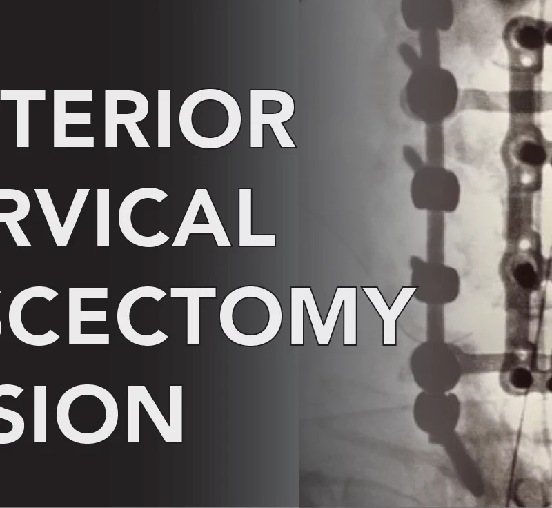 Anterior Cervical Discectomy and Fusion Surgery