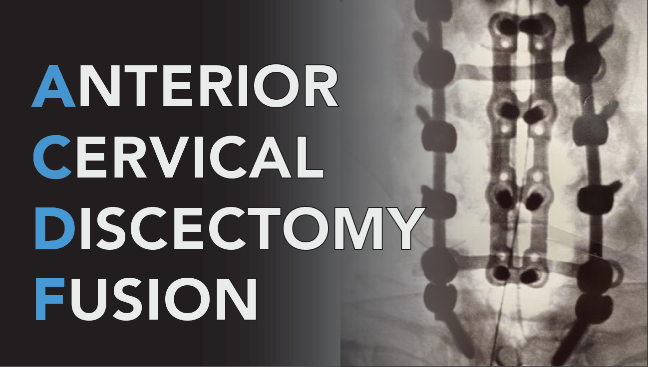 Anterior Cervical Discectomy and Fusion Surgery