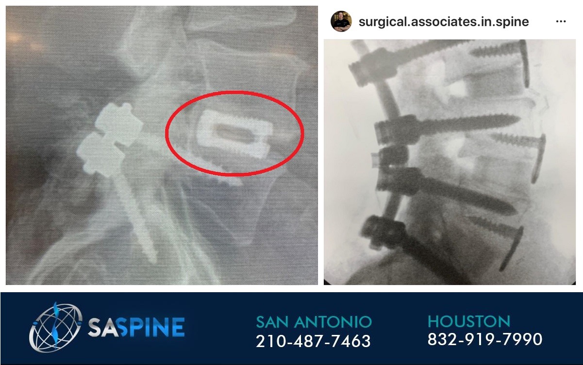 Anterior Revision Surgery