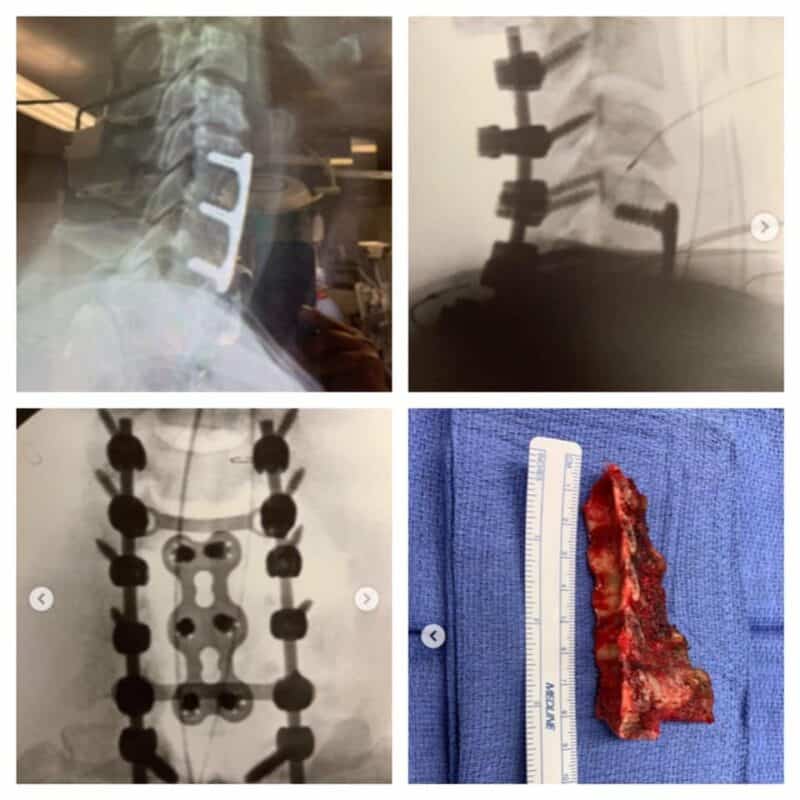 Posterior Cervical Fusion and Laminectomy