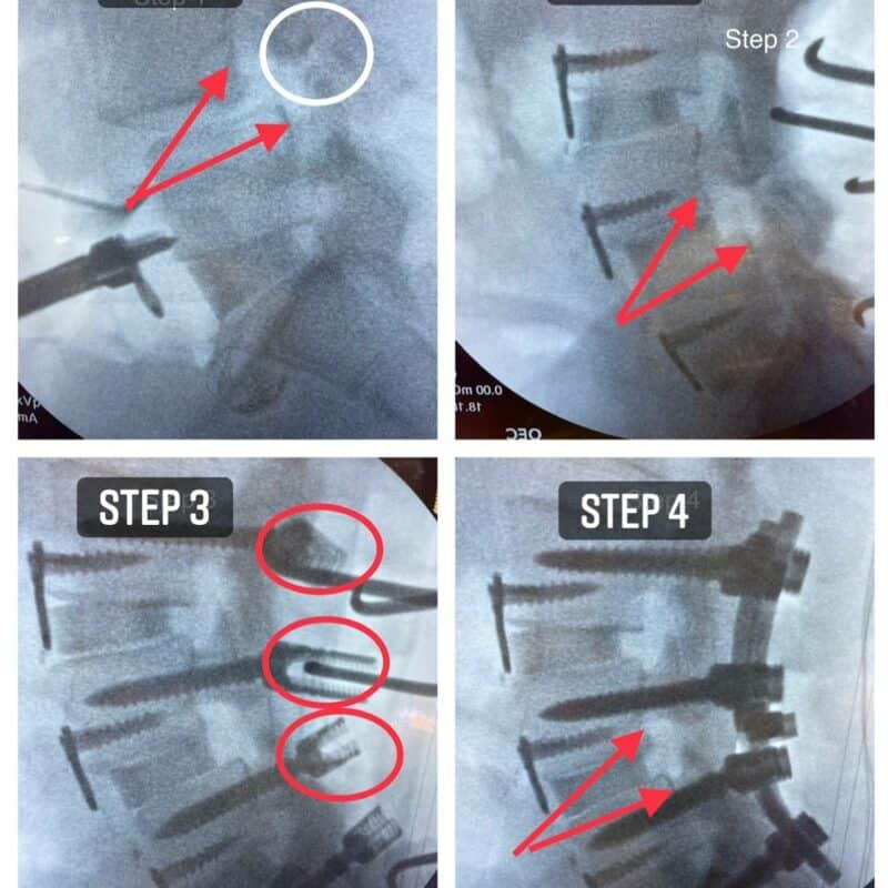 Spondylolisthesis Reduction