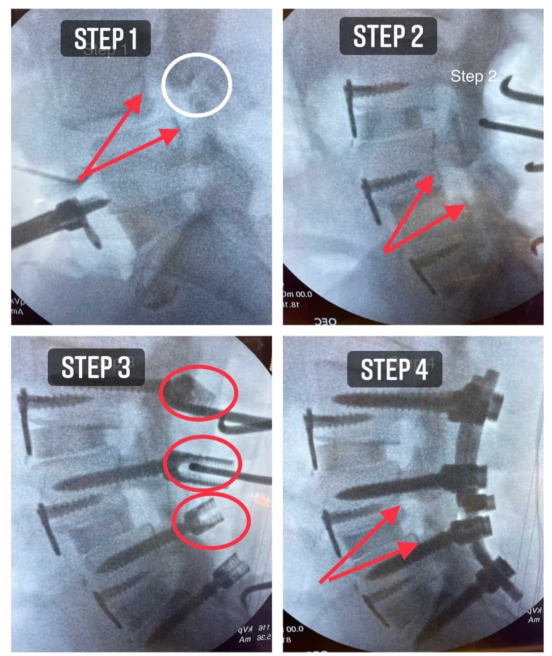 Spondylolisthesis Reduction