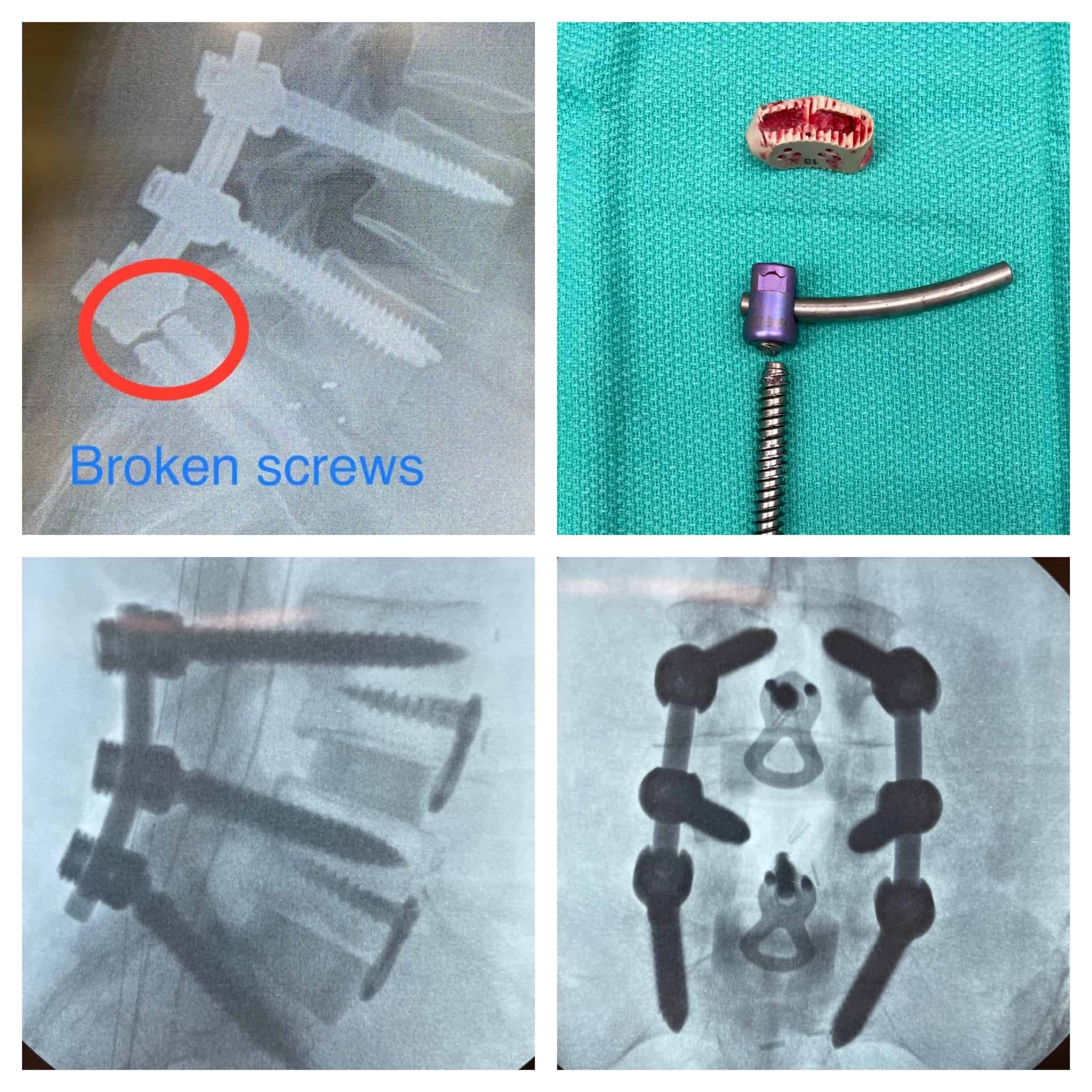Revision Spine Surgery