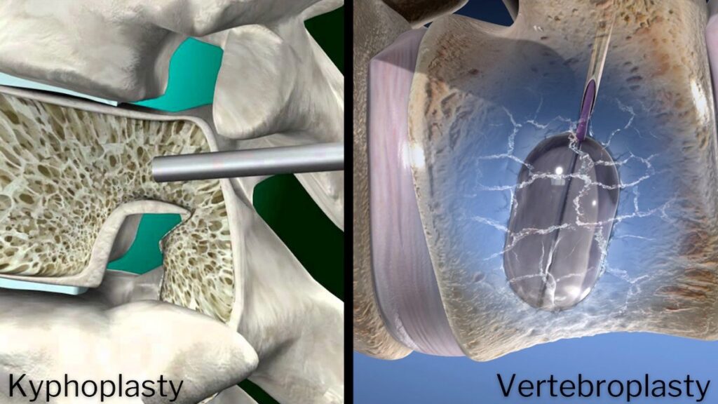 Kyphoplasty Vertebroplasty