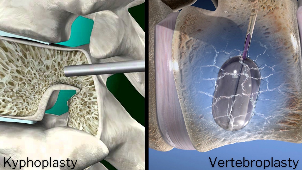 What Are Kyphoplasty Vertebroplasty Surgeries? SA Spine
