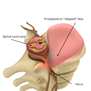 Lumbar fusion slipped disc