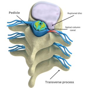 Lumbar fusion 