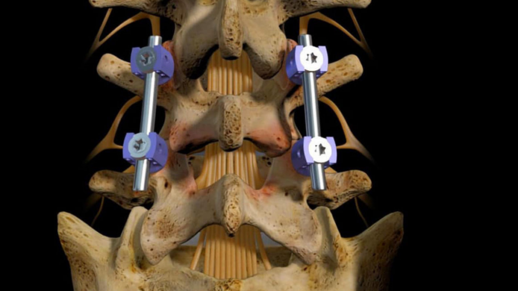 Lumbar fusion