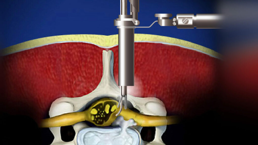 Microdiskectomy surgery