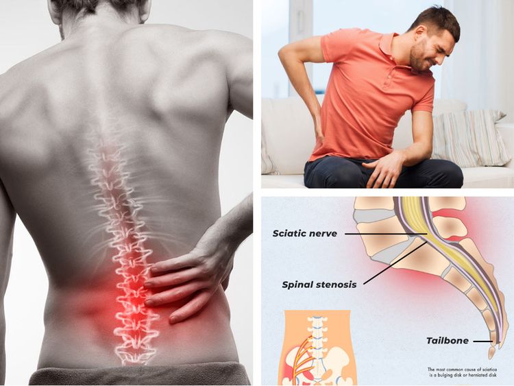 relieve sciatica pain