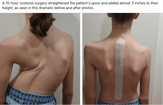 Dextroscoliosis